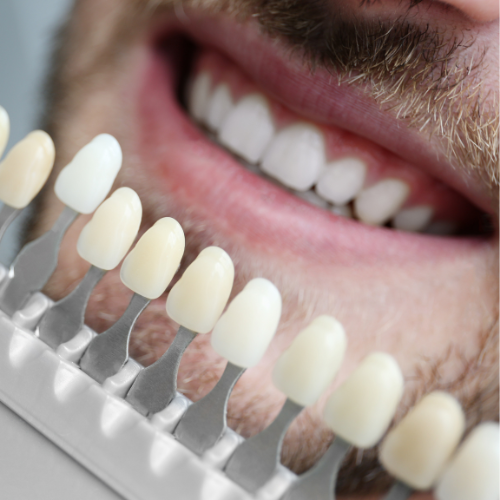 Lentes de Contato Dental: O Que São e Como Transformam o Sorriso?